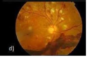 増殖性網膜症の眼底写真